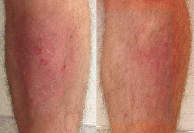 Psoriasis treatment after a month