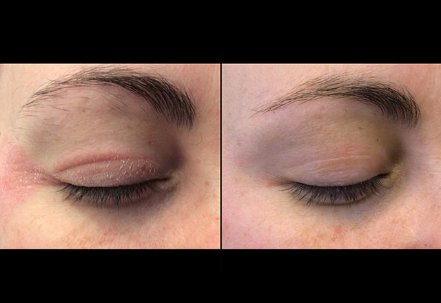 Treatment for Eyelid Dermatitis