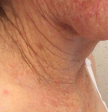After treatment