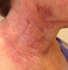 Before treatment