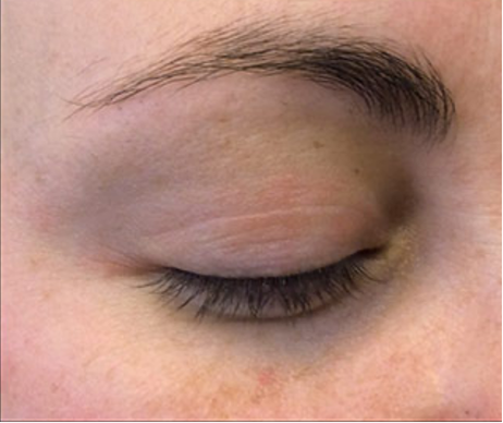 After treatment