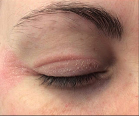 Before treatment