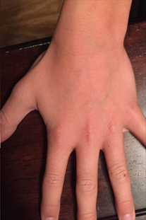 After treatment