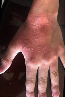 Before treatment